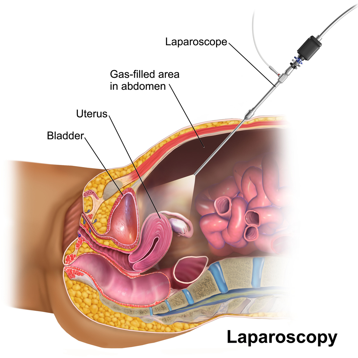 laparoscopic hiatal hernia repair | MedEase | Healthcare Services in India
