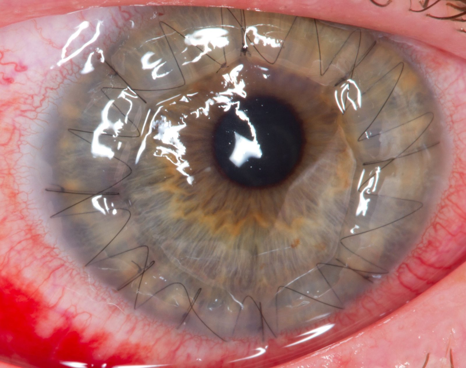 cornea transplant | MedEase | Healthcare Services in India