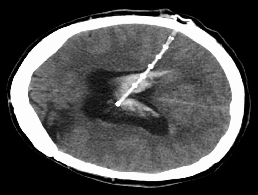 ventriculoperitoneal shunt | MedEase | Healthcare Services in India