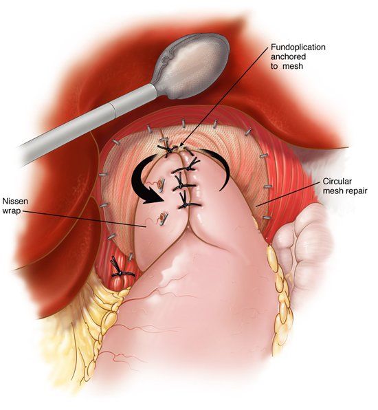 Laparoscopic Hiatal Hernia Surgery showing fundoplication and mesh placement