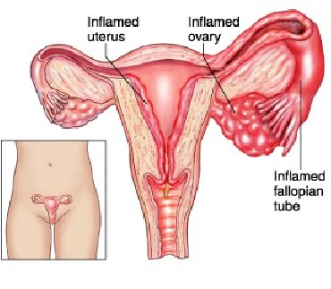 Illustration showing inflamed uterus, fallopian tubes, and ovaries – medical conditions related to abortion in India.